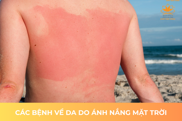 Các Bệnh Về Da Do Ánh Nắng Mặt Trời 